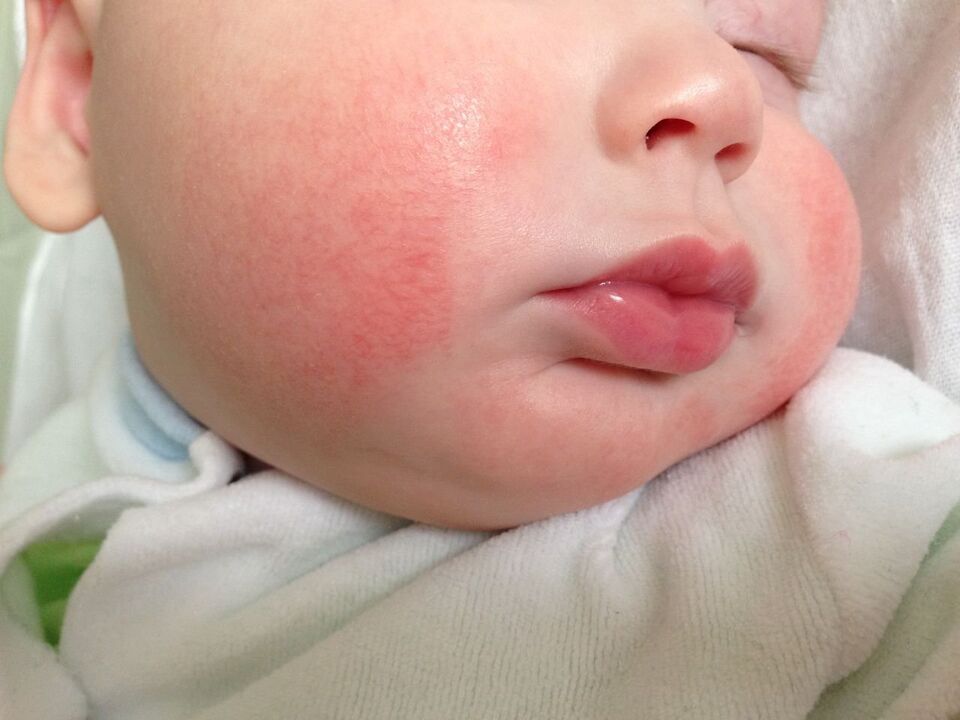 Ein Zeichen von Würmern bei einem Kind ist allergische Urtikaria